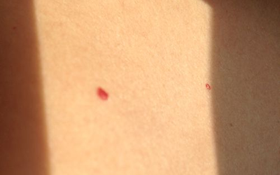 胸口有红痣代表什么