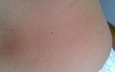 胸口有红痣代表什么