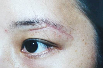 眉毛有伤疤的面相代表什么