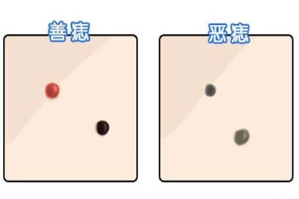 手 上长痣