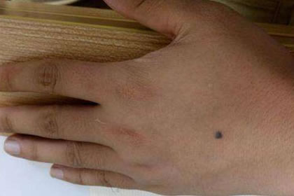 手上长痣什么情况 痣长在手指上怎么样